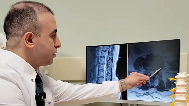 Bel Fıtığı Hakkında Uzman Uyarıları: Ameliyat Son Çare Olmalı